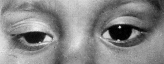 Myasthenia gravis